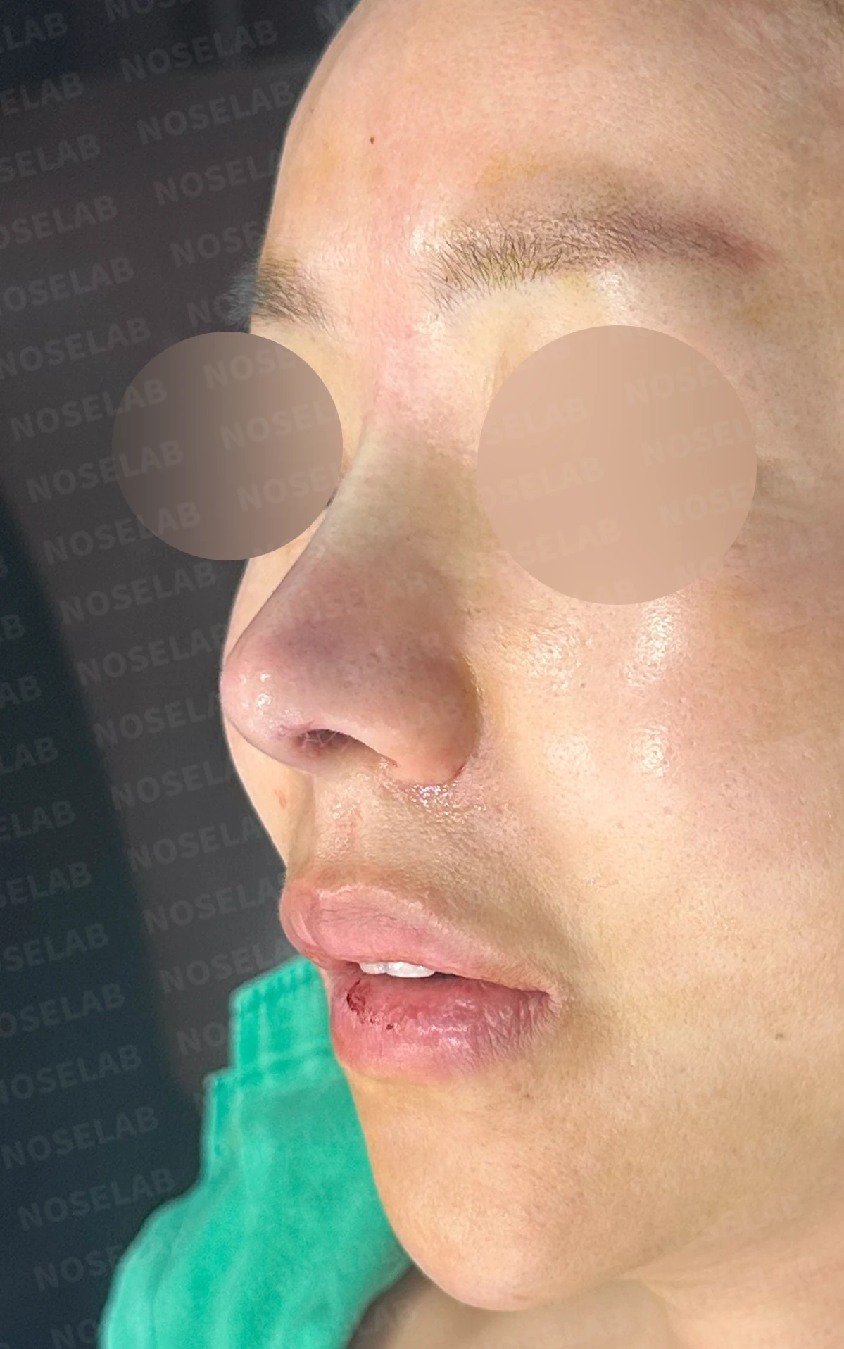 보형물을 제거한 뒤 콧대가 꺼지고 퍼지는 이유, 재건은 어떻게 하나 — 수술 직후 0일 정면, 비스듬한 측면, 측면 사진입니다. 직후 사진은 부기가 있는 상태로 최종 결과와 다를 수 있습니다.