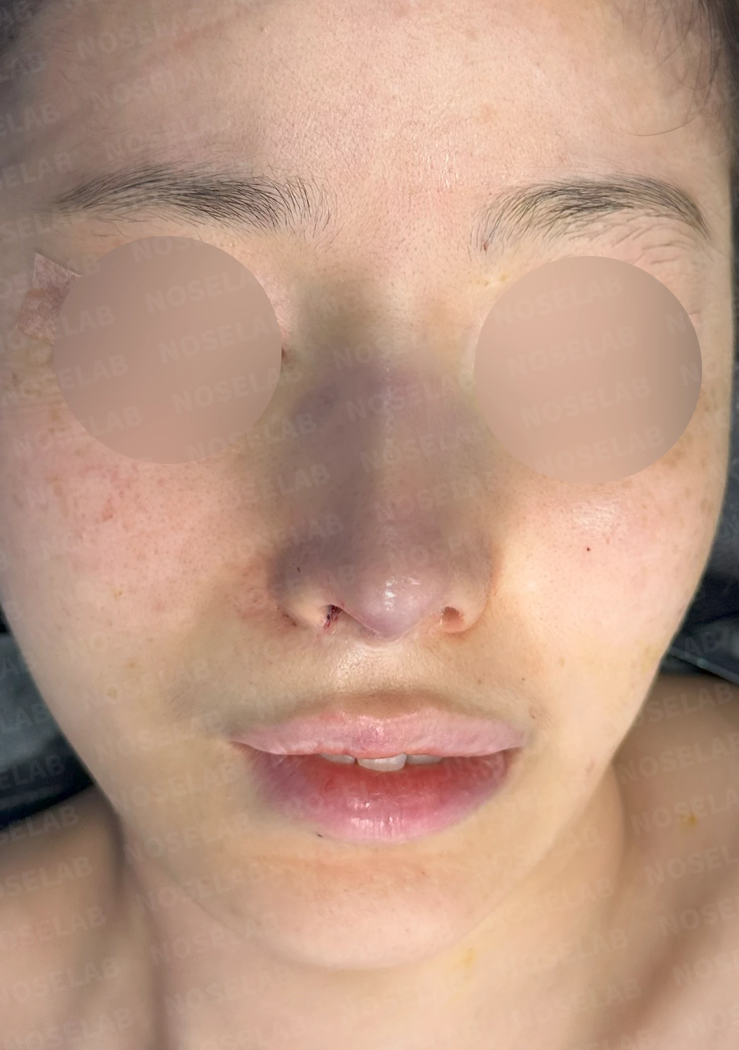 귀연골만으로 코끝을 받쳤을 때 생기는 변화와 늑연골 재건 방법 — 본문 사진 8