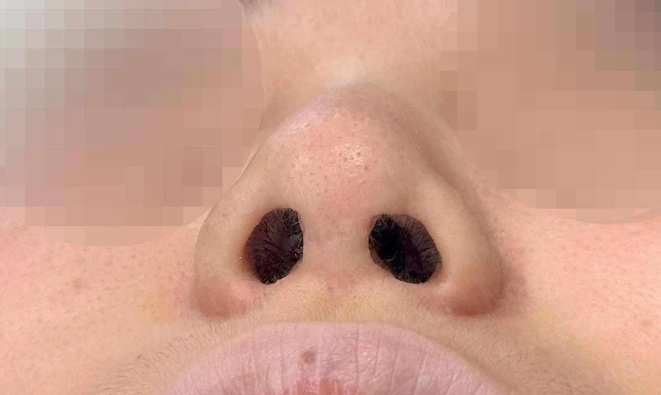 알레르기 체질에서 자가늑연골 무보형물 코성형을 계획할 때 — 수술 전 / 수술 직후 0일 직후 사진은 부기가 있는 상태로 최종 결과와 다를 수 있습니다.
