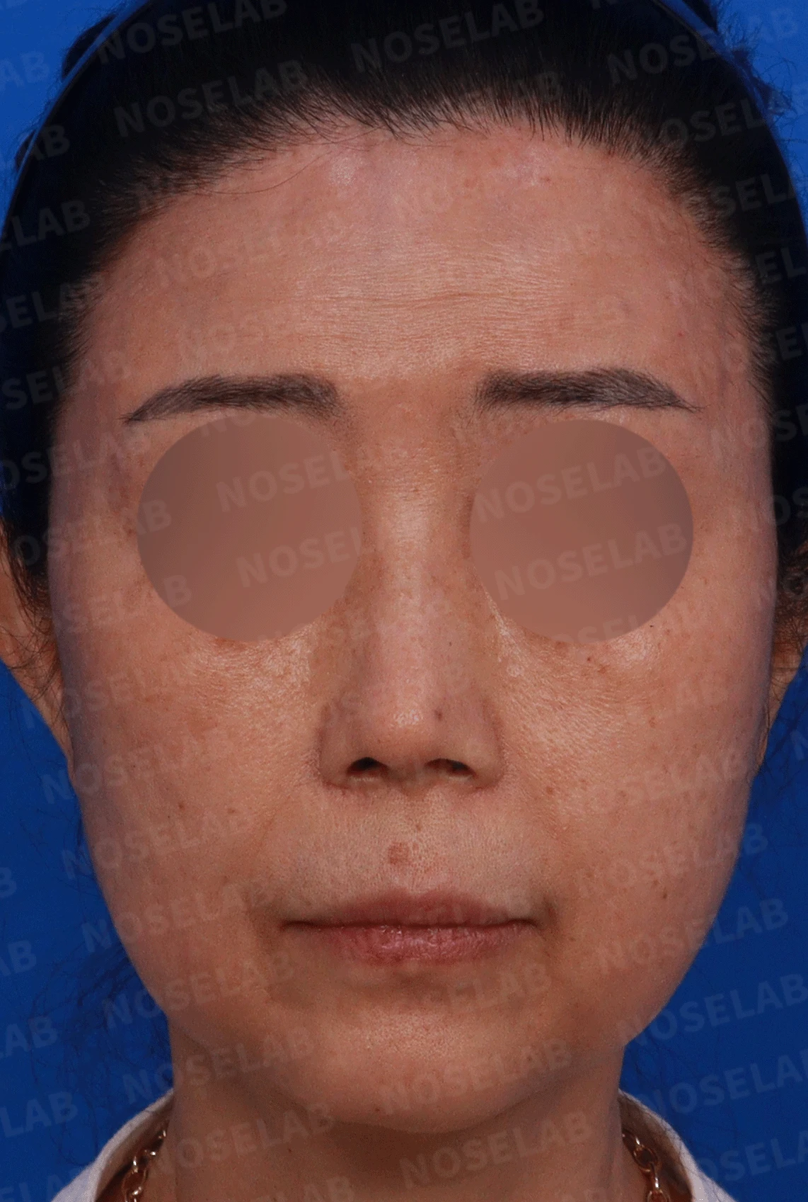 여러 차례 수술에도 코가 계속 휘는 이유, 비중격 연골 재건 방법 — 디자인 상담 정면 , 좌측 비스듬한 측면 , 측면 사진입니다.