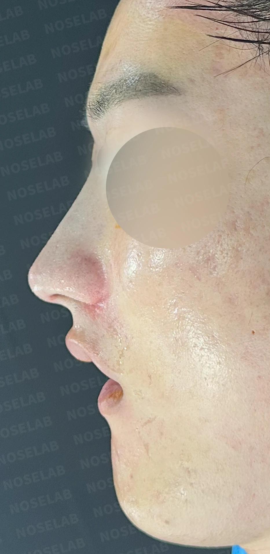 보형물 없이 코끝과 경계 부분만 교정하는 방법 — 수술 직후 0일 정면 , 측면 , 비스듬한 측면 사진 직후 사진은 부기가 있는 상태로 최종 결과와 다를 수 있습니다.