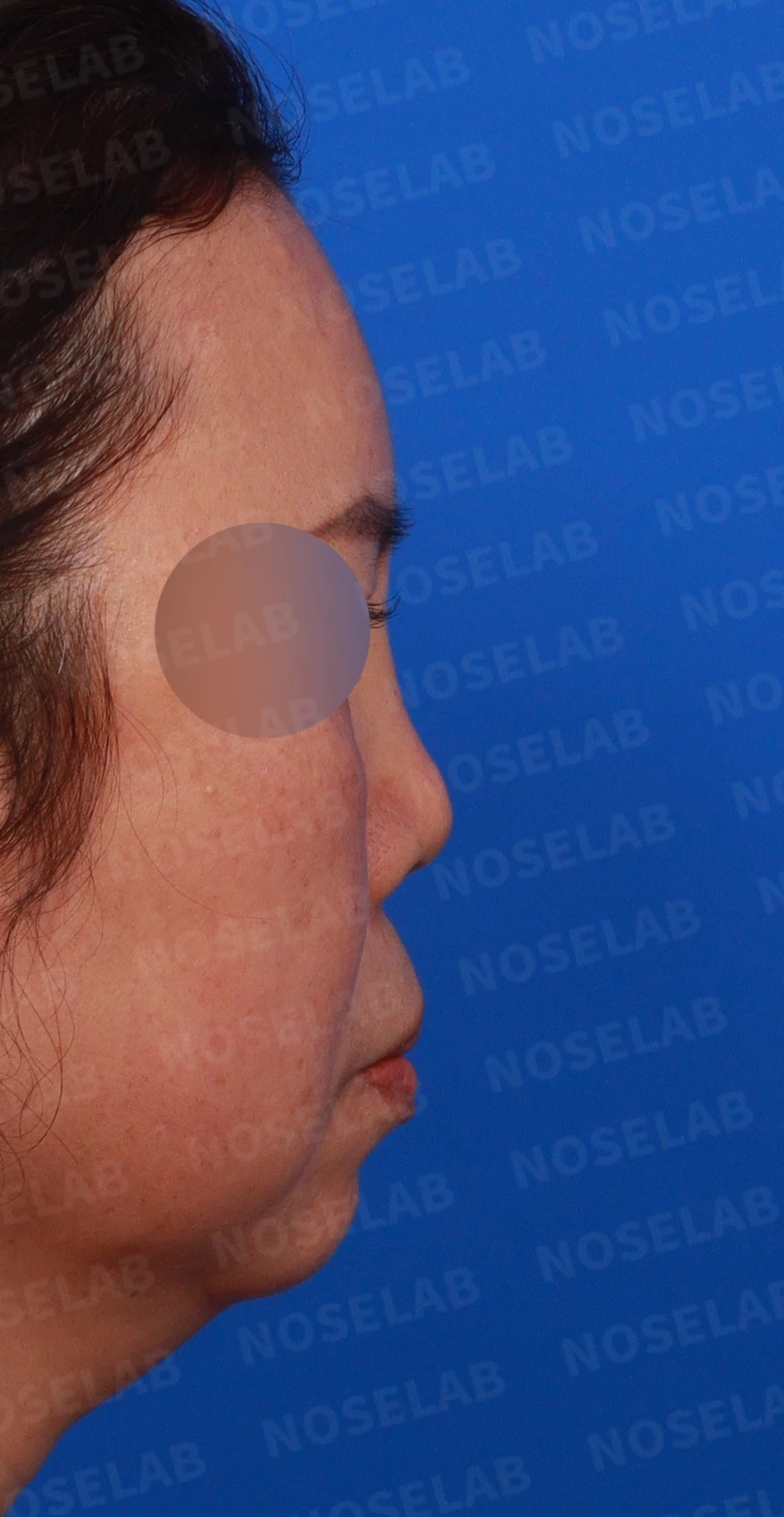 불법 주사 시술 뒤 코가 들리고 짧아지는 이유, 이물질 제거와 재건은 어떻게 하나 — 디자인 상담 우측 비스듬한 측면, 측면, 비공 사진