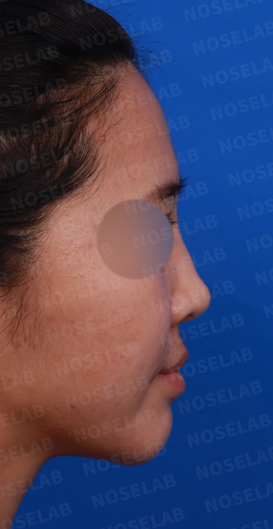코필러 제거, 코막힘 해결 사례 — 디자인 상담 우측 비스듬한 측면, 측면, 비공 사진