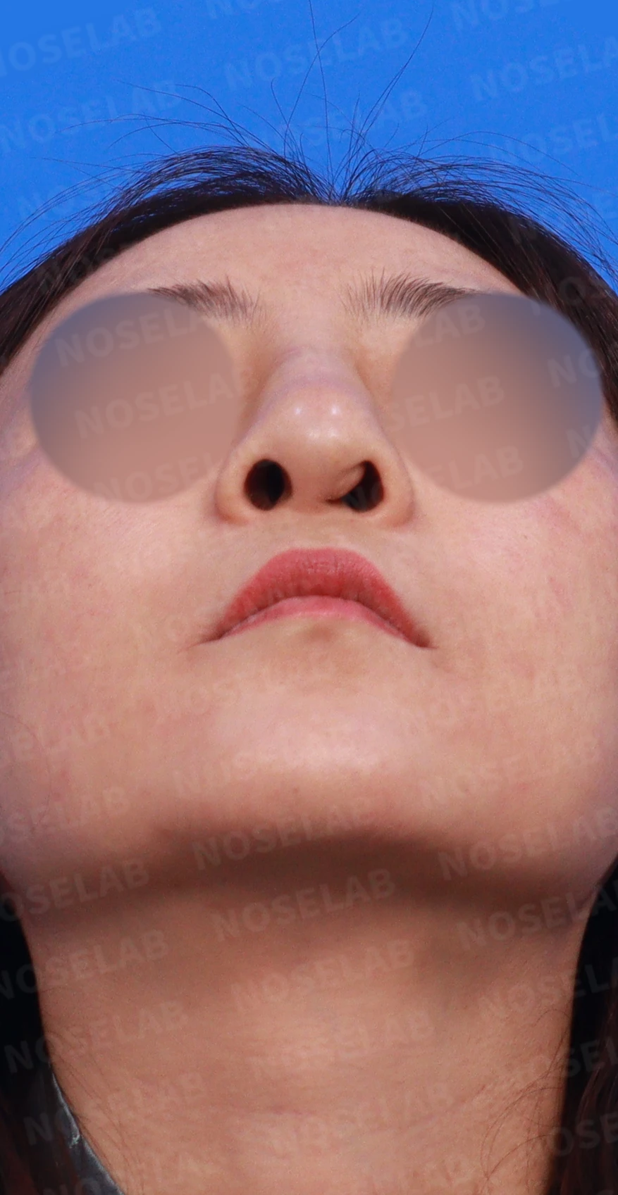 무자격 불법 주사 뒤 콧구멍이 좁아지는 이유와 제거·재건 방법 — 디자인 상담 우측 비스듬한 측면, 측면, 비공 사진입니다.