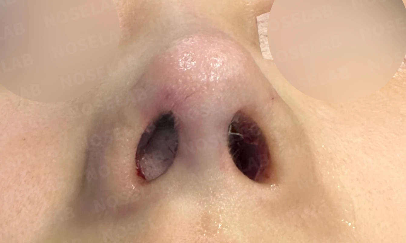 코가 한쪽으로 휘어 보이고 밤에 막히는 이유, 비중격 재건과 코막힘 개선 — 수술 직후 0일 비공 사진입니다. 직후 사진은 부기가 있는 상태로 최종 결과와 다를 수 있습니다.