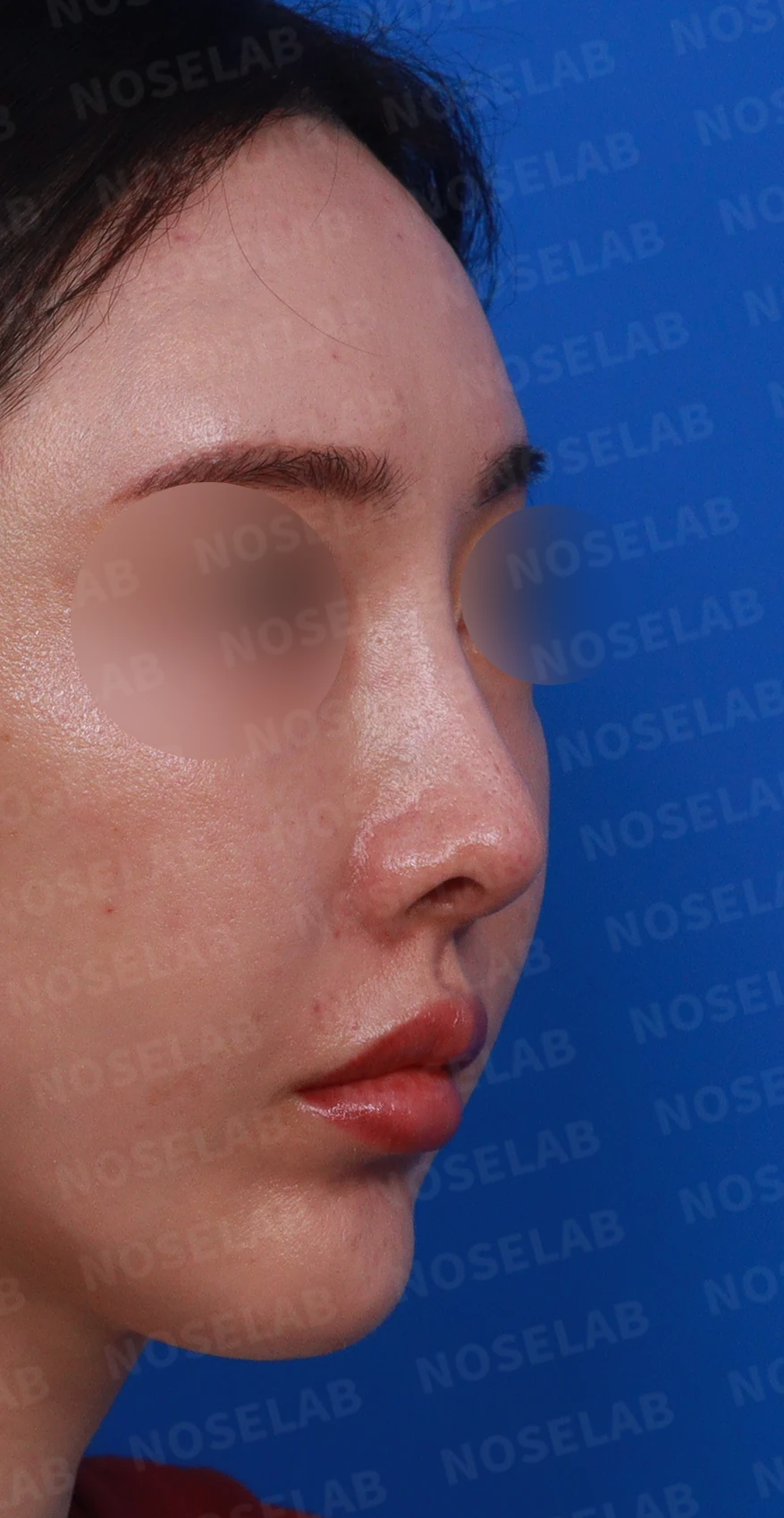 코성형 후 염증이 반복되는 이유와 자가 조직만으로 재건하는 방법 — 디자인 상담 우측 비스듬한 측면 , 측면 , 비공 사진입니다.