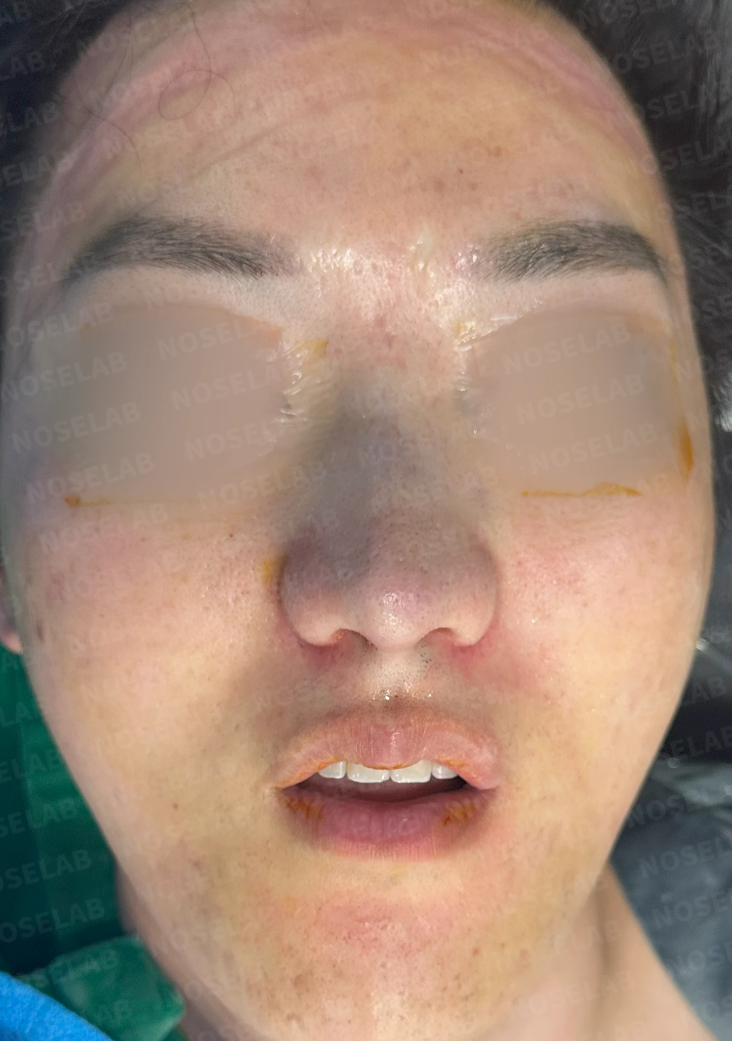 보형물 없이 코끝과 경계 부분만 교정하는 방법 — 수술 직후 0일 정면 , 측면 , 비스듬한 측면 사진 직후 사진은 부기가 있는 상태로 최종 결과와 다를 수 있습니다.
