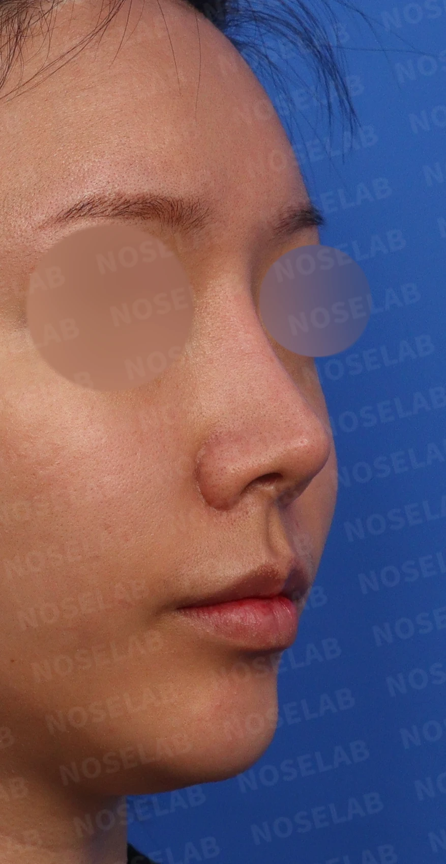 휜코와 콧구멍 비대칭, 호흡을 함께 고려한 교정 방법 — 수술전 디자인 상담 정면, 비스듬한 측면, 측면 사진입니다.