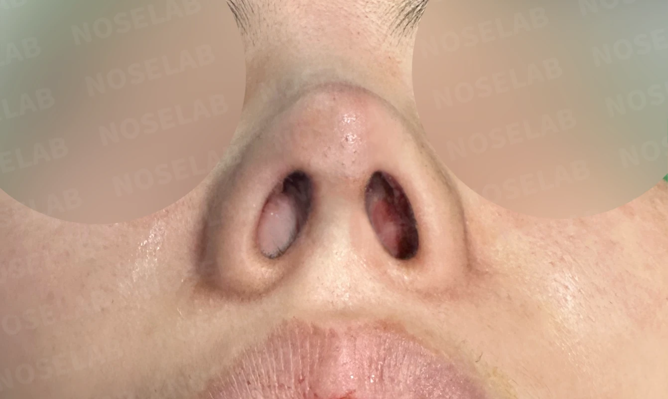 L자 실리콘 보형물이 비주 점막을 뚫기 직전까지 가는 이유, 제거와 자가늑연골 재건 방법 — 수술 전 / 수술 직후 0일 직후 사진은 부기가 있는 상태로 최종 결과와 다를 수 있습니다.