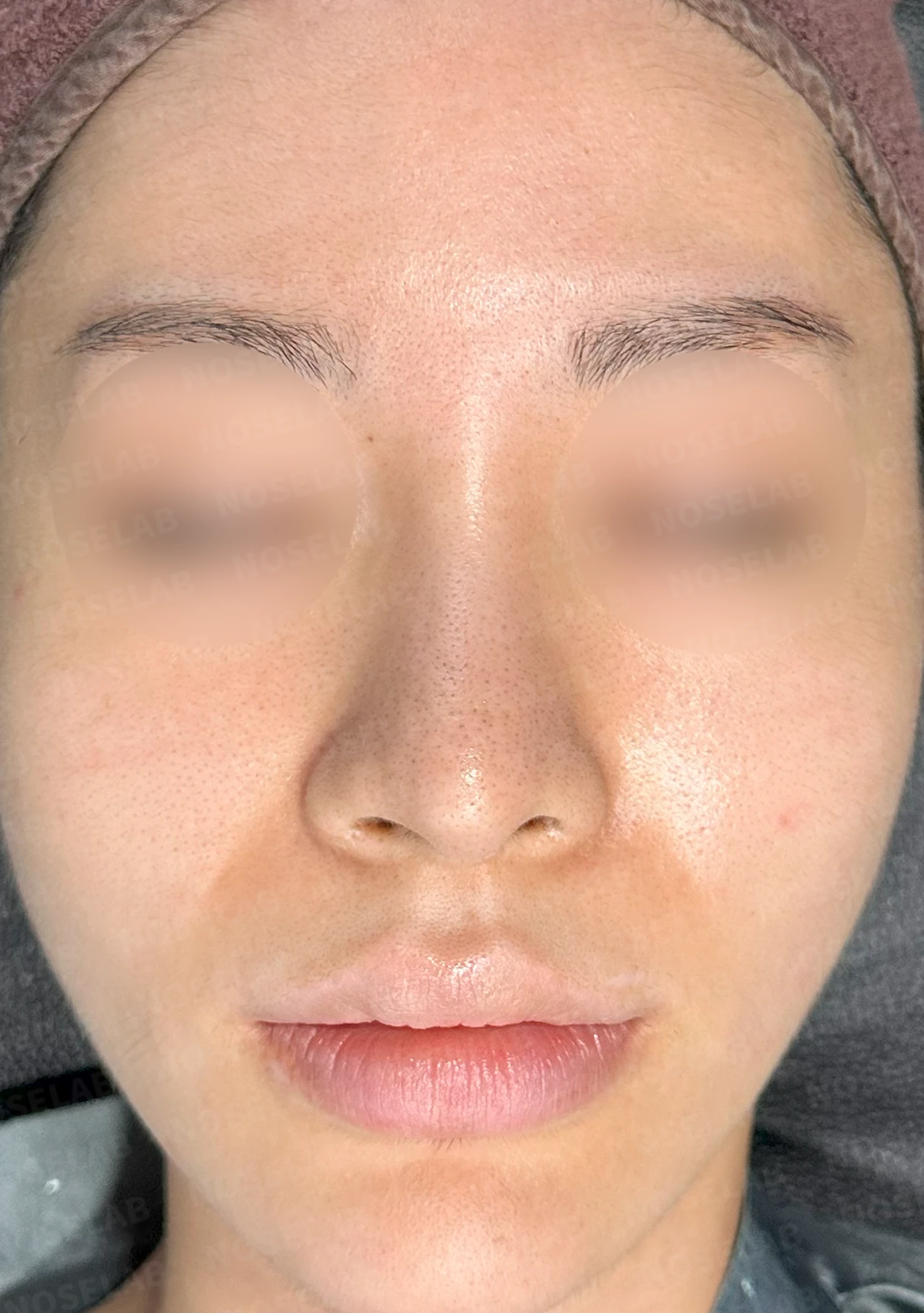여러 코 모양 고민을 함께 살펴보는 코성형 계획 — 수술 전 / 수술 직후 0일 직후 사진은 부기가 있는 상태로 최종 결과와 다를 수 있습니다.