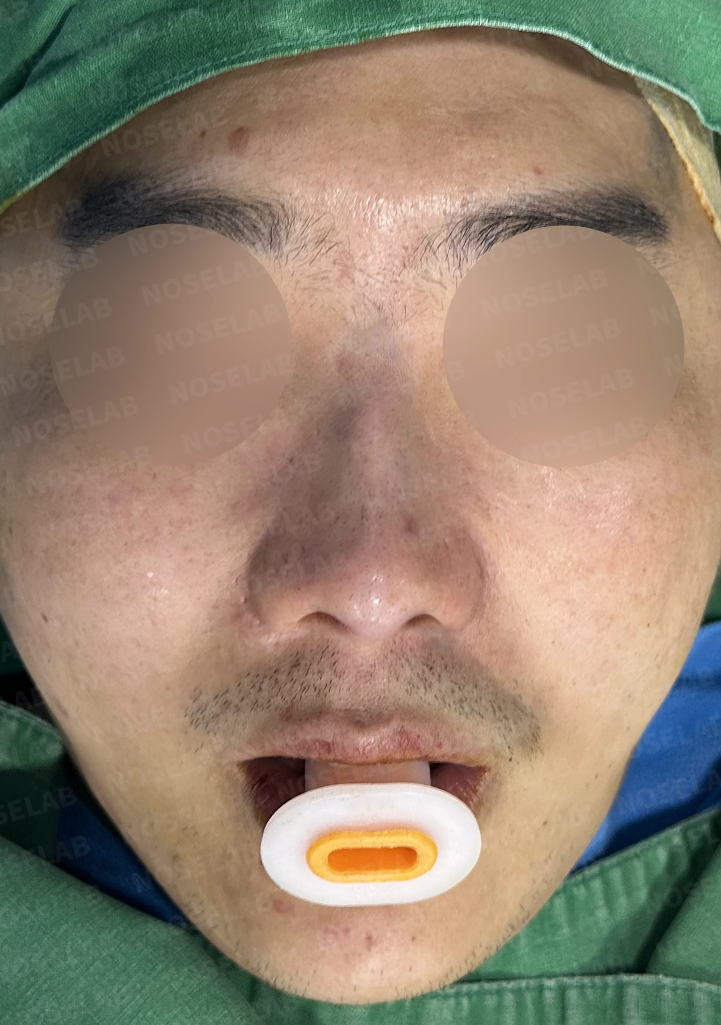 휜코 교정과 비공 비대칭, 자가늑연골로 바로잡은 코재수술 — 전(좌) 직후(후)