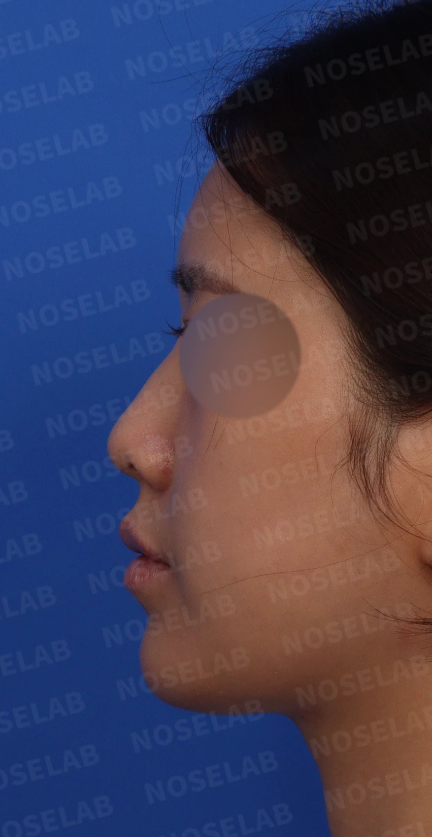 돌출입과 비순각을 함께 살펴보는 코성형 계획 — 수술전 디자인 상담 정면, 좌측 비스듬한 측면, 측면 사진입니다.