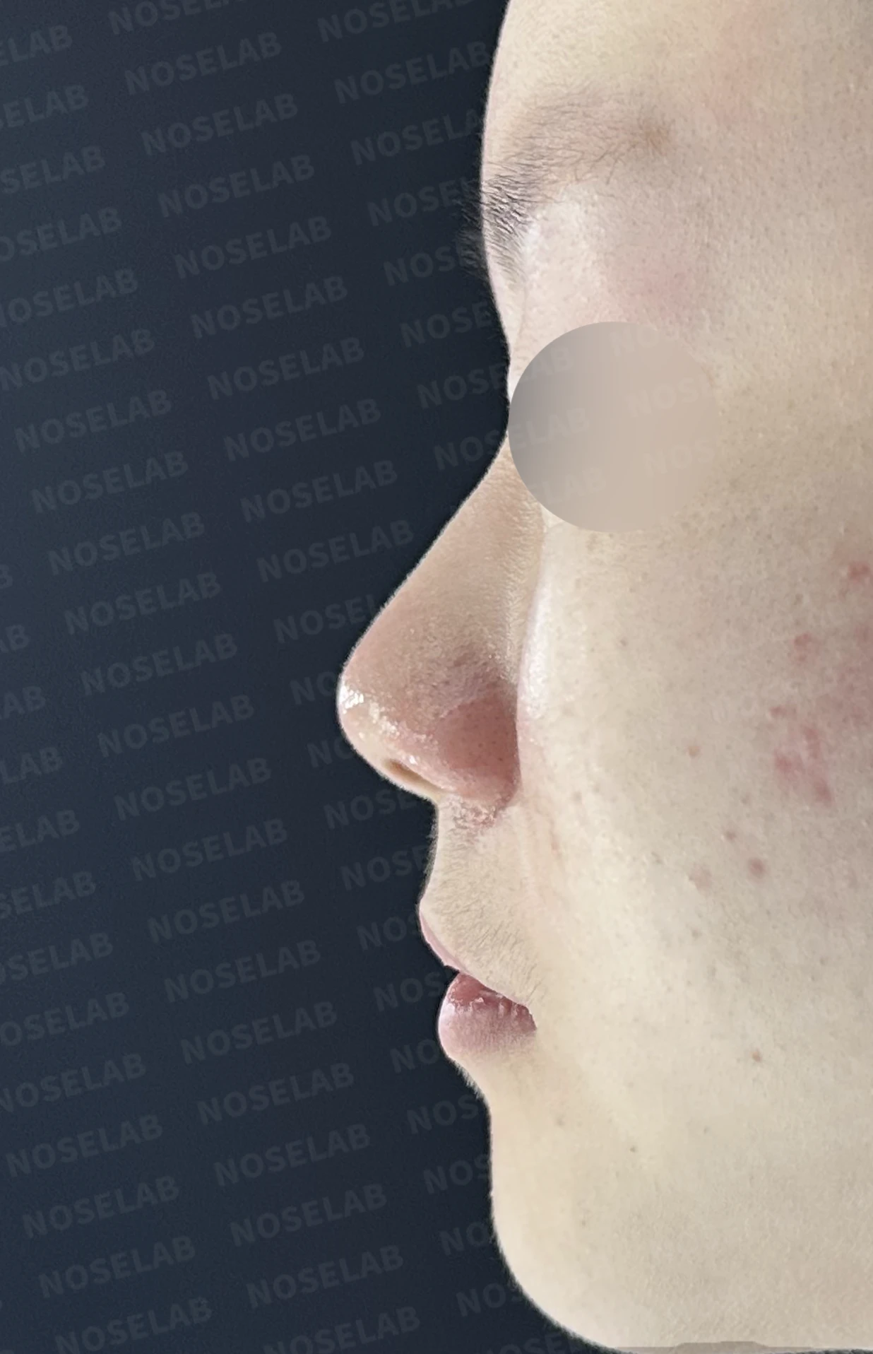 콧대가 퍼져 보이고 코끝이 뭉툭한 이유, 절골술과 자가 늑연골 교정은 어떻게 하나 — 수술 전 / 수술 직후 0일 직후 사진은 부기가 있는 상태로 최종 결과와 다를 수 있습니다.