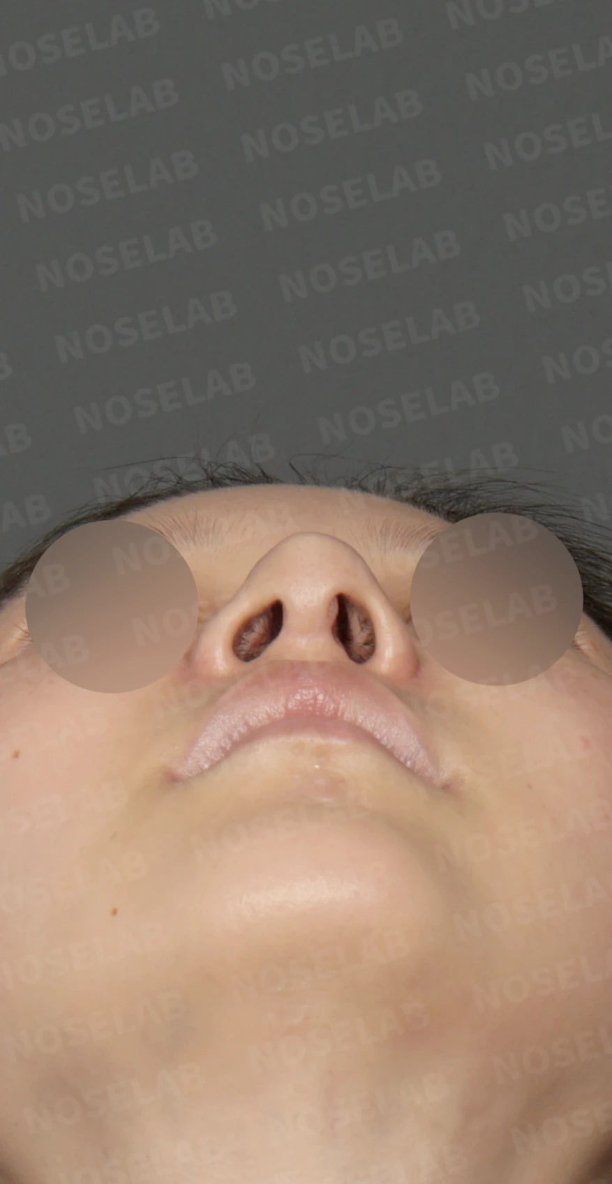 휘어진 코와 복코, 자가늑연골 비중격 재건으로 안전하게 교정한 코재수술 — 디자인 상담 우측 측면, 비스듬한 측면, 비공 사진입니다.