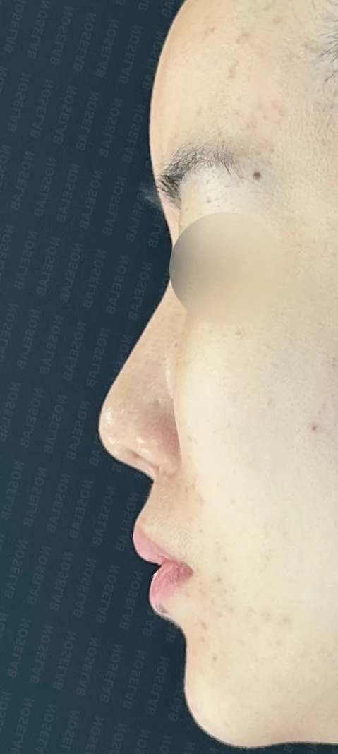 휜코, 뭉툭하고 처진코 수술 사례_대표원장 강차영 — 본문 사진 2