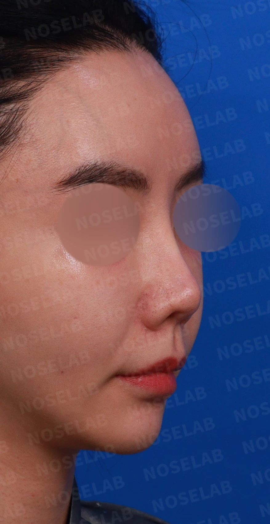 이식한 진피가 반복해서 흡수되는 이유, 재건은 어떻게 하나 — 디자인 상담 우측 비스듬한 측면, 측면, 비공 사진입니다.