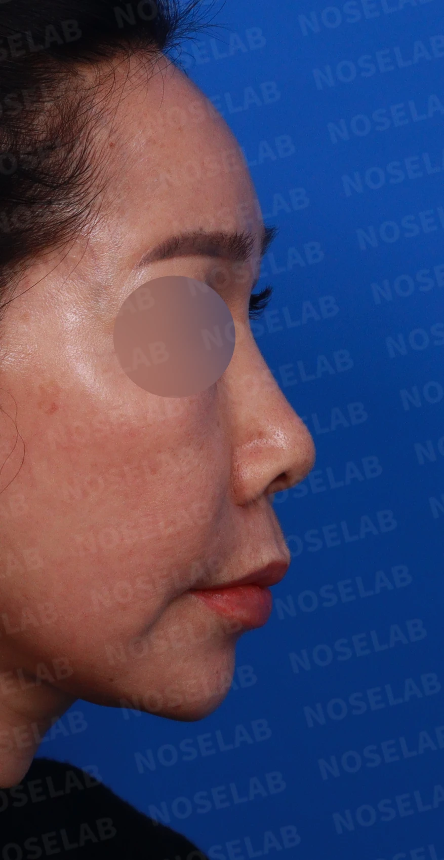 코 안에 남은 메드포어와 이물질, 왜 문제가 되고 어떻게 제거하나 — 디자인 상담 우측 비스듬한 측면, 측면, 비공 사진