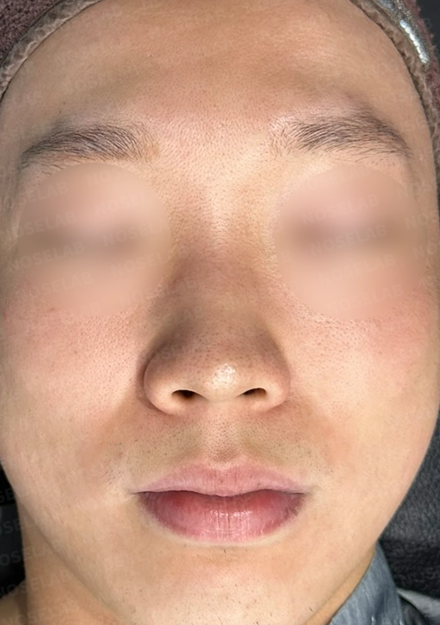 들린코, 작은코, 비순각 교정 사례 - 기능과 미용을 동시에 잡다 — 수술전(좌) 수술직후(우)