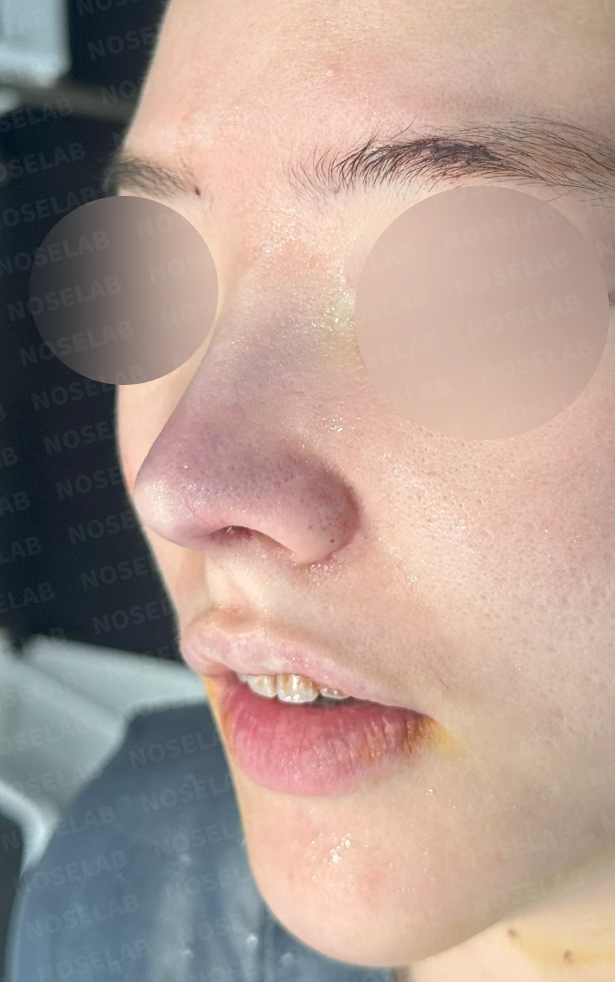 코끝이 퍼지고 입체감이 없어 보이는 이유, 복코 교정은 어떻게 하나 — 수술 직후 0일 정면, 측면, 비스듬한 측면 사진 직후 사진은 부기가 있는 상태로 최종 결과와 다를 수 있습니다.