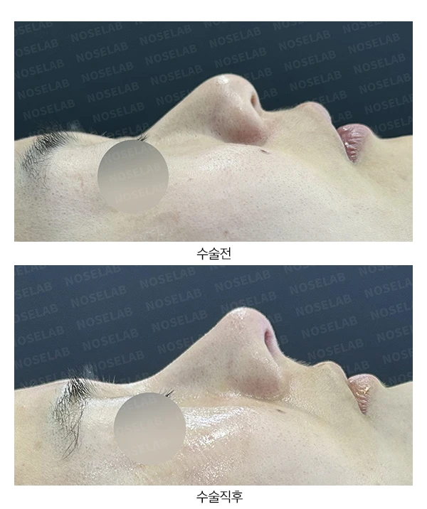 복코 수술은 어떻게 하나요? — 전후 비교