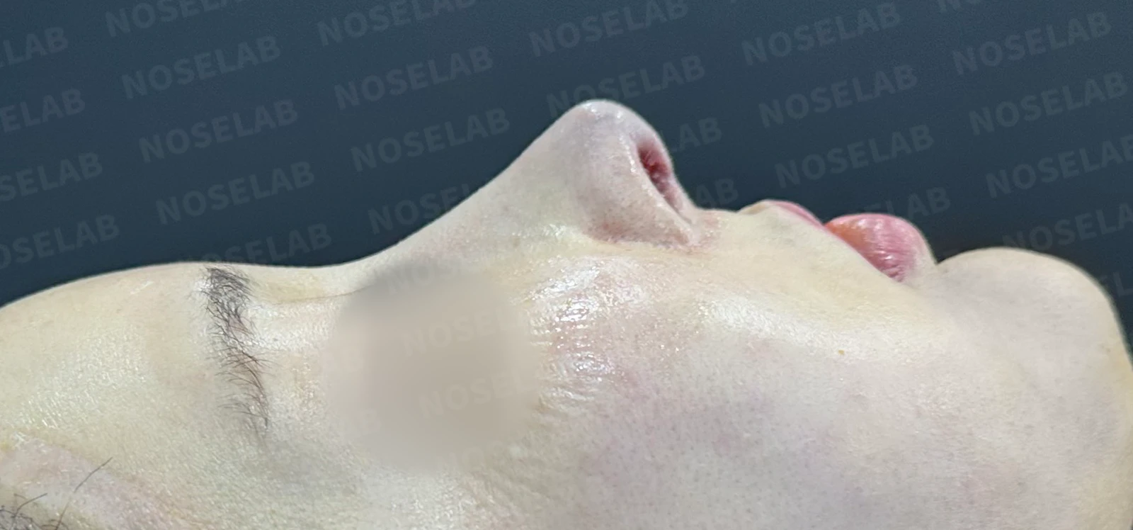 수술 후 14일 조기 교정에서 확인할 점 — 수술 전 / 수술 직후 0일 직후 사진은 부기가 있는 상태로 최종 결과와 다를 수 있습니다.