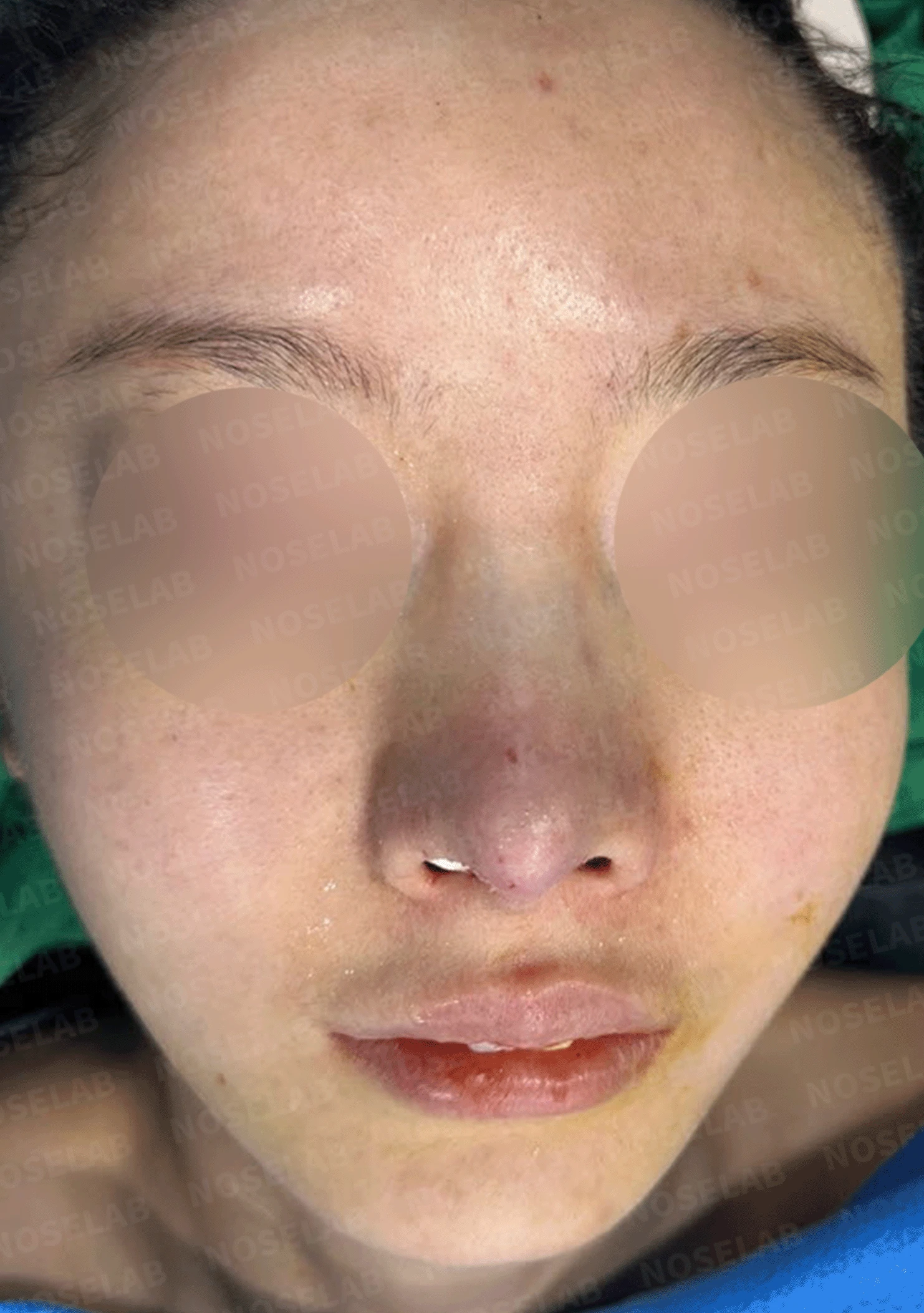실리콘 보형물이 코끝 피부를 뚫고 나오려 할 때, 왜 생기고 어떻게 재건하나 — 수술 직후 0일 정면, 측면, 비스듬한 측면 사진 직후 사진은 부기가 있는 상태로 최종 결과와 다를 수 있습니다.