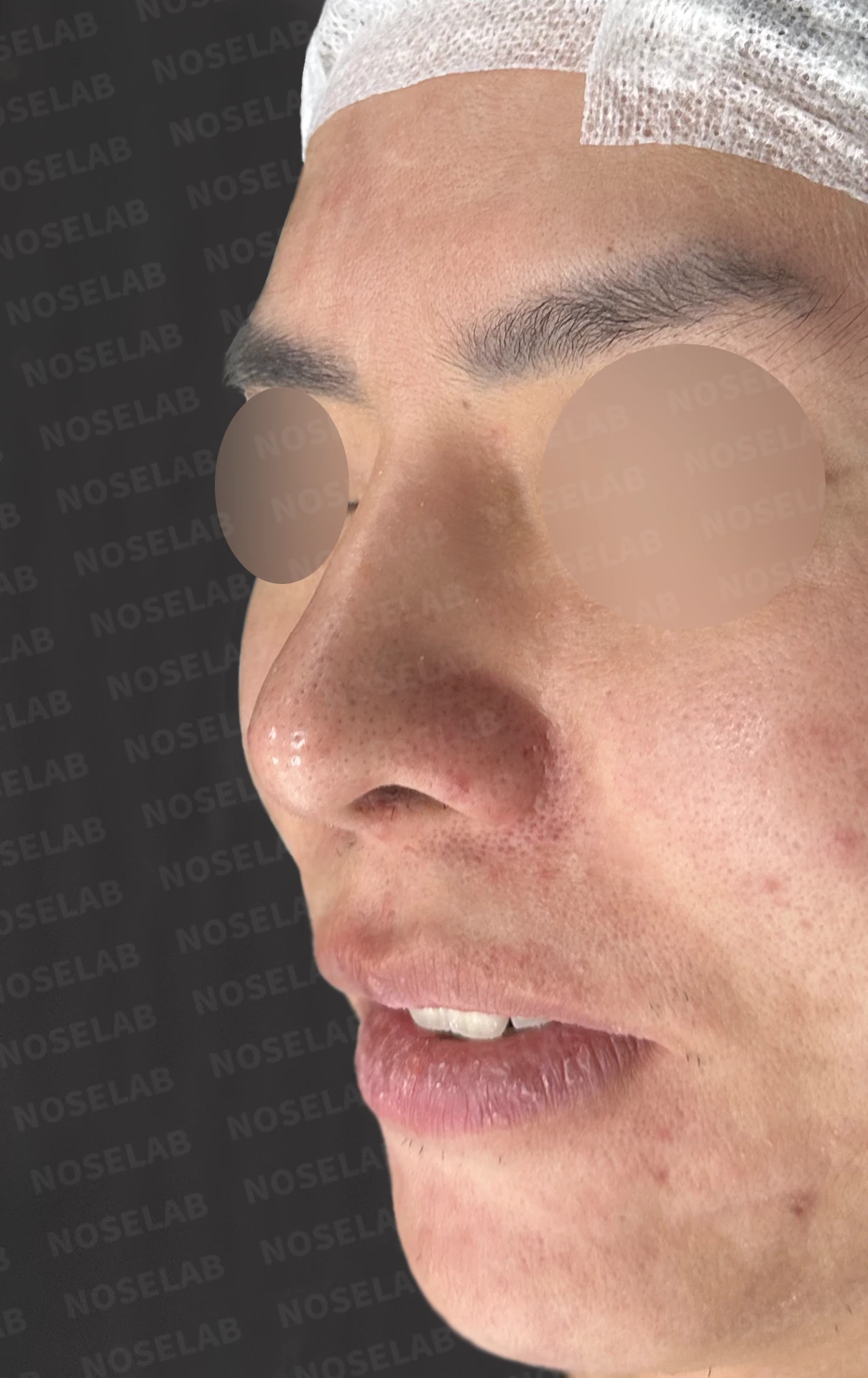 코재수술과 코막힘 교정, 기능과 심미 모두 잡은 비개방 코성형 사례 — 전(좌) 직후(후)
