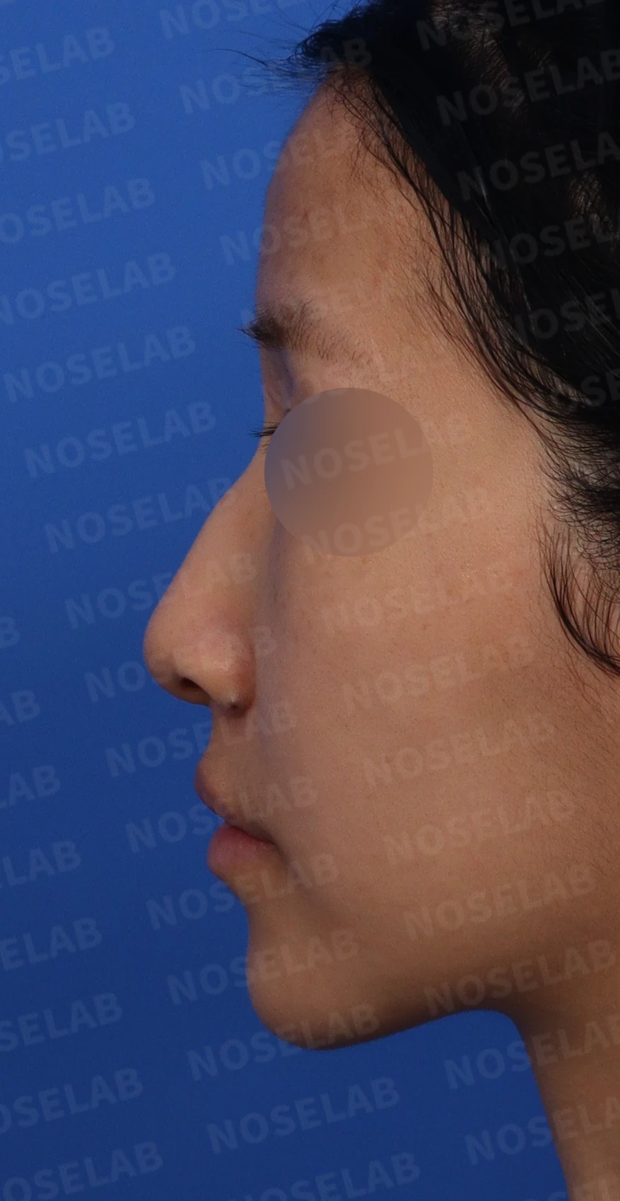 긴 코와 매부리코, 얼굴 비율을 고려한 교정 방법 — 디자인 상담 좌측 비스듬한 측면, 측면, 콧구멍 사진입니다.