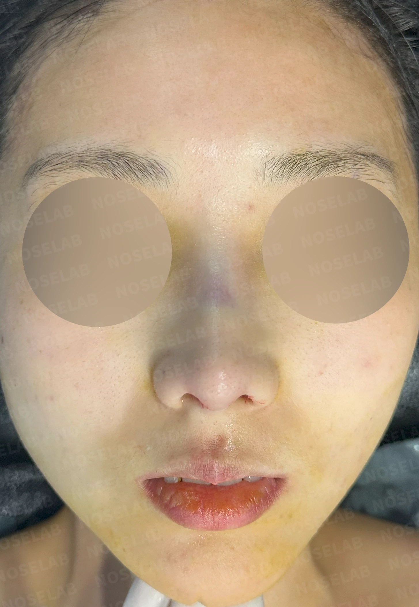 작은 코와 비공 비대칭을 함께 살펴보는 교정 방법 — 수술 직후 0일 정면, 측면, 비스듬한 측면 직후 사진은 부기가 있는 상태로 최종 결과와 다를 수 있습니다.