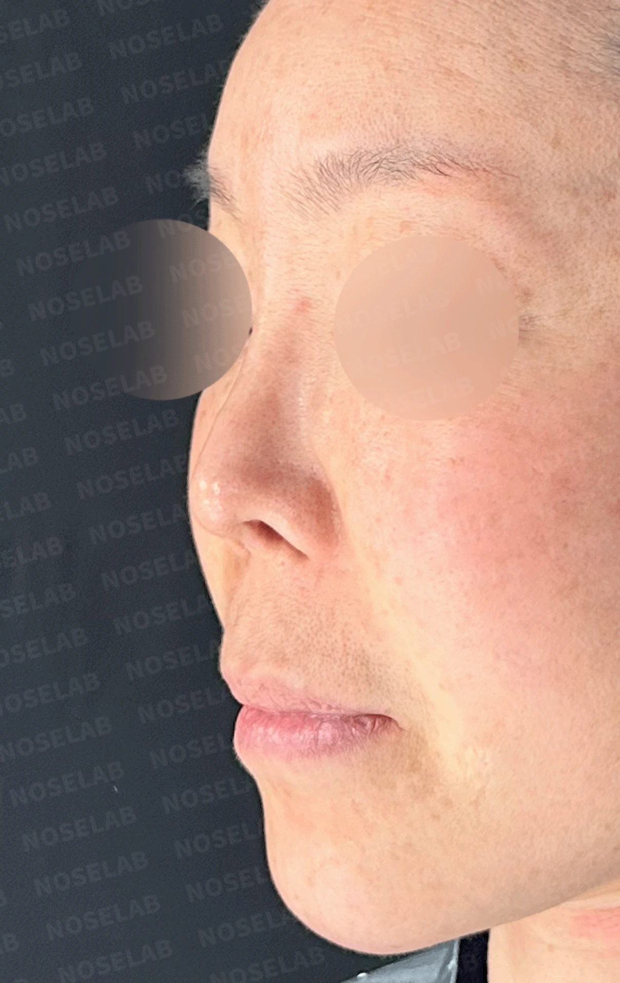 코가 짧고 들리며 비주가 함몰되는 이유, 자가 늑연골 재건은 어떻게 하나 — 본문 사진 12