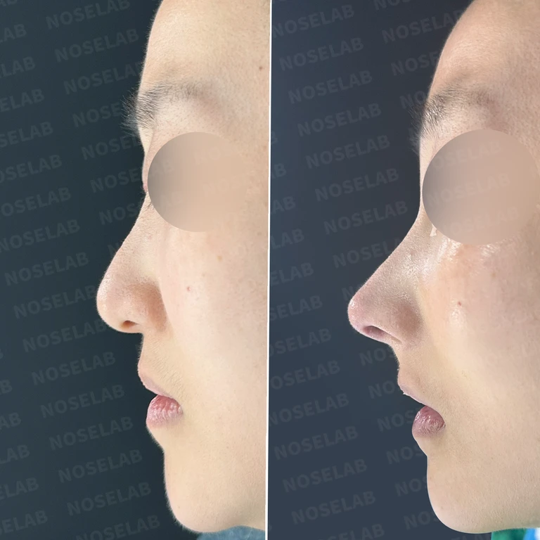 휘어진 코와 긴 코 개선, 안면 비대칭 교정까지 - 자가늑연골 재건+코막힘 개선 수술 실제 후기 — 전후 비교