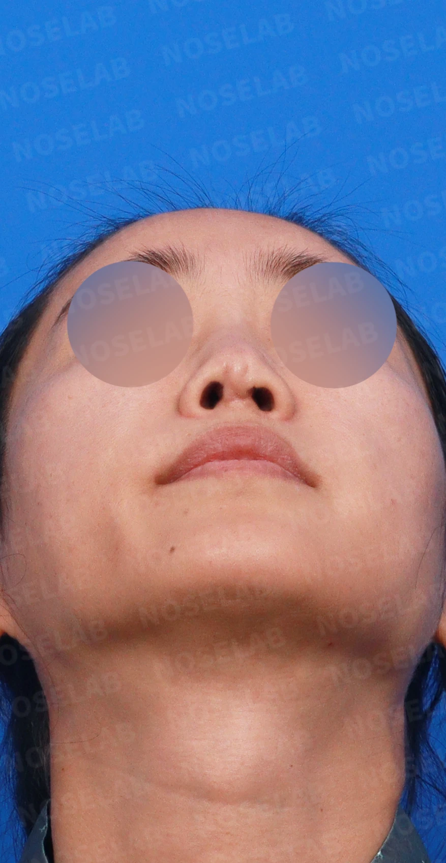 콧대에 주입한 불법 시술 이물질, 제거와 비중격 전체 재건은 어떻게 하나 — 디자인 상담 우측 측면, 비스듬한 측면, 비공 사진입니다.