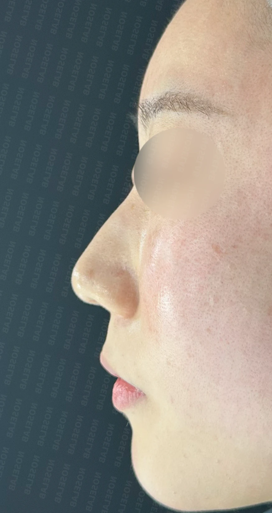 코뼈 비대칭과 처진 코끝에 만성 비염이 겹칠 때 보는 것 — 수술 전 / 수술 직후 0일 직후 사진은 부기가 있는 상태로 최종 결과와 다를 수 있습니다.