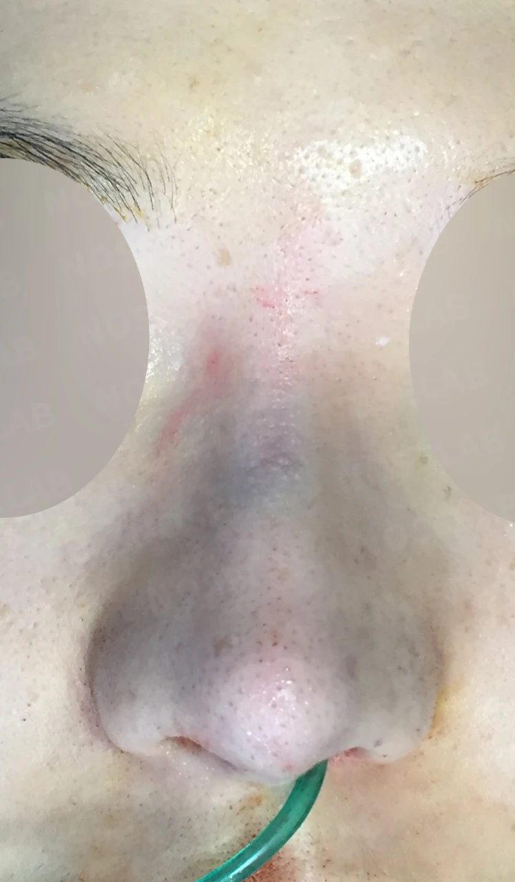 매부리 코·휜 코·뭉툭한 코·콧구멍 비대칭 교정 코 수술 방법 — 본문 사진 6