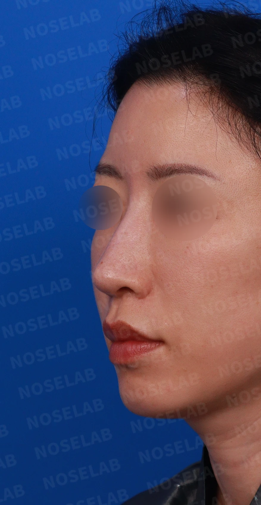 충격을 받은 뒤 코끝에서 소리가 나고 모양이 달라지는 이유와 늑연골 재건 — 디자인 상담 정면 , 좌측 비스듬한 측면 , 측면 사진입니다.