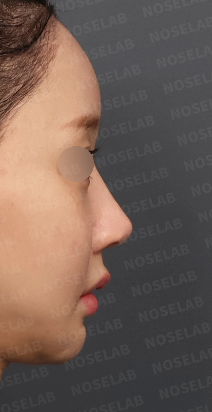 여러 차례 코수술 후 자가늑연골과 자가진피로 코 전체를 자연스럽게 높인 재수술 — 디자인 상담 우측 측면, 비스듬한 측면, 비공 사진입니다.