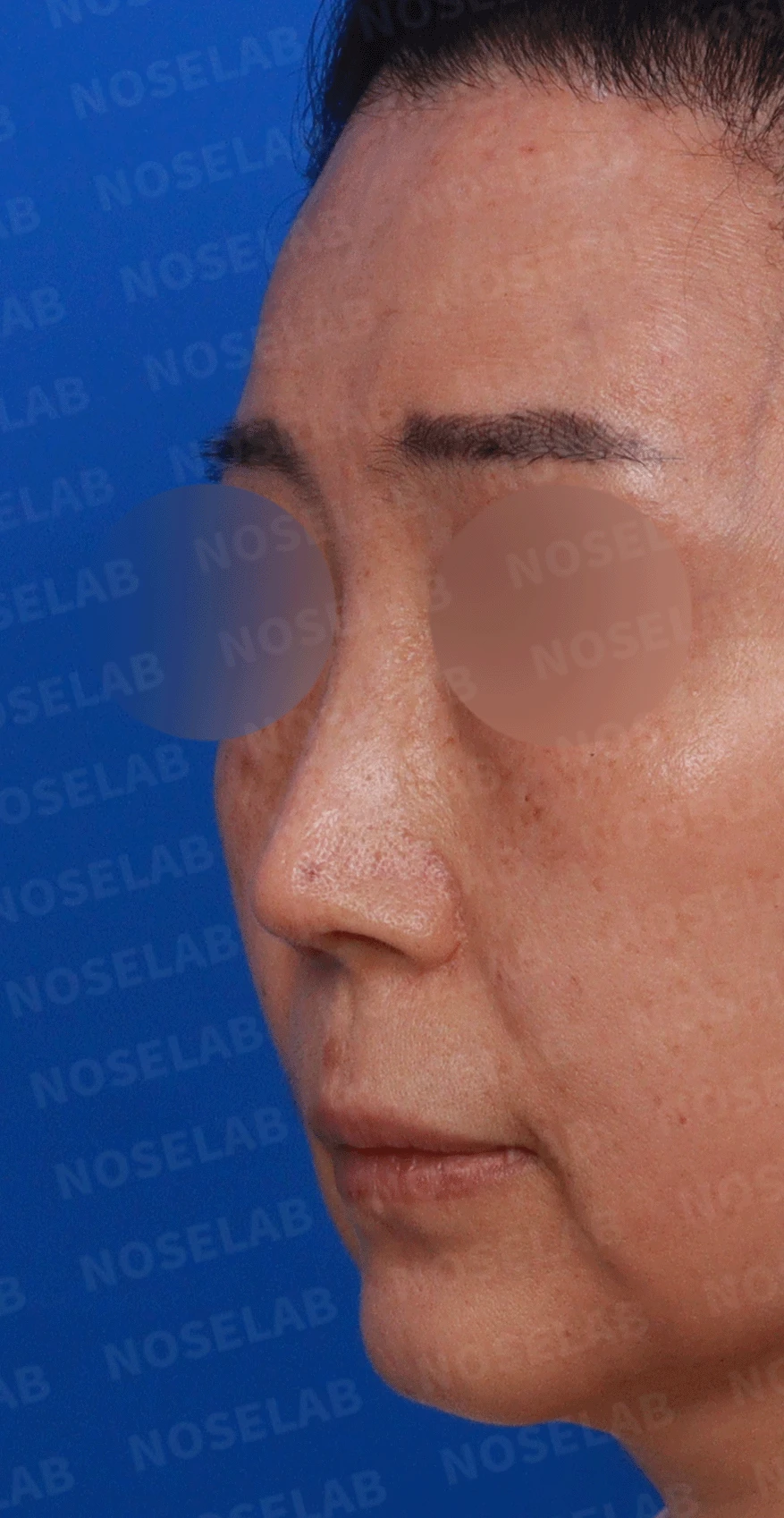 여러 차례 수술에도 코가 계속 휘는 이유, 비중격 연골 재건 방법 — 디자인 상담 정면 , 좌측 비스듬한 측면 , 측면 사진입니다.