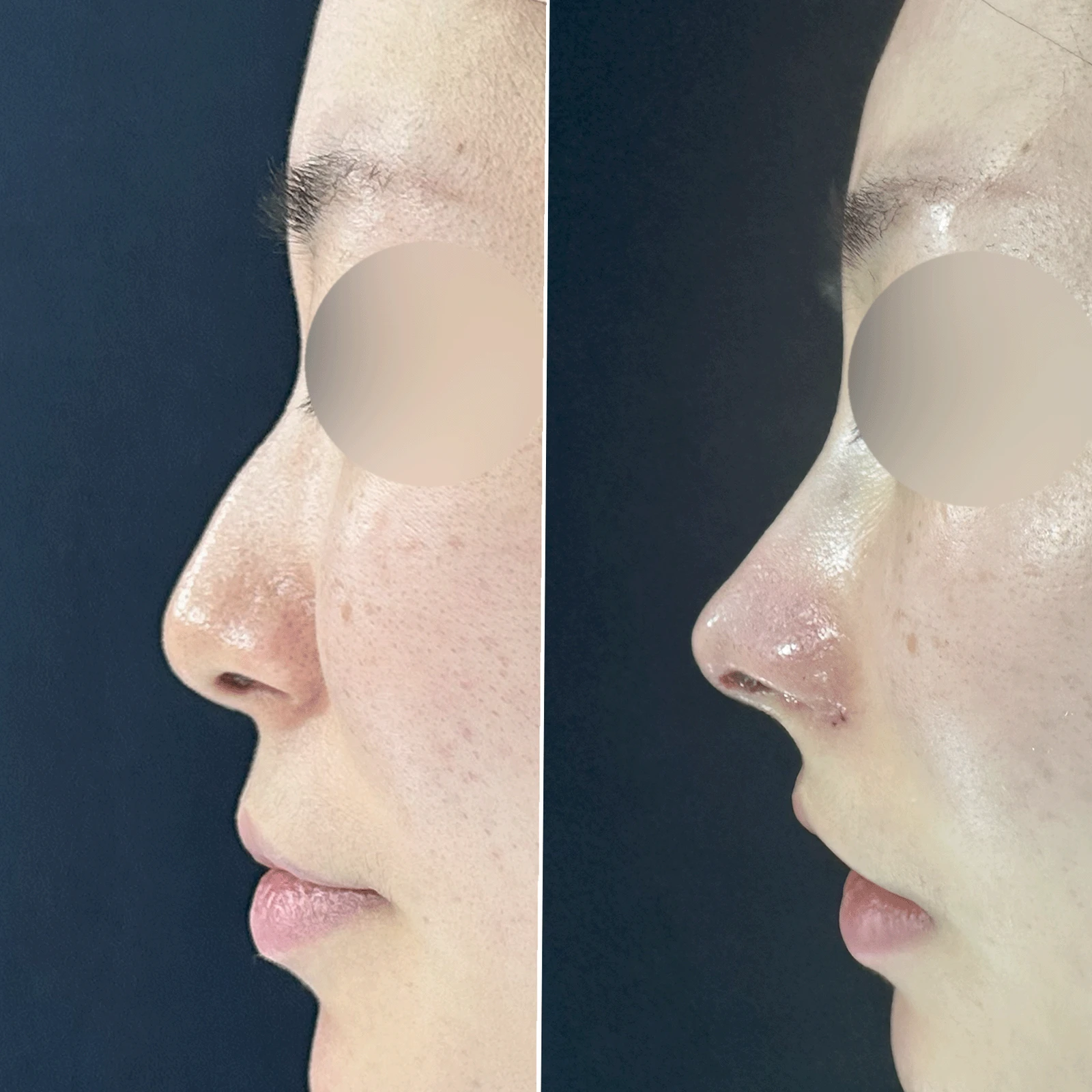 매부리코와 휜 코에 코막힘이 함께 오는 이유, 복합 교정은 어떻게 하나 — 본문 사진 20