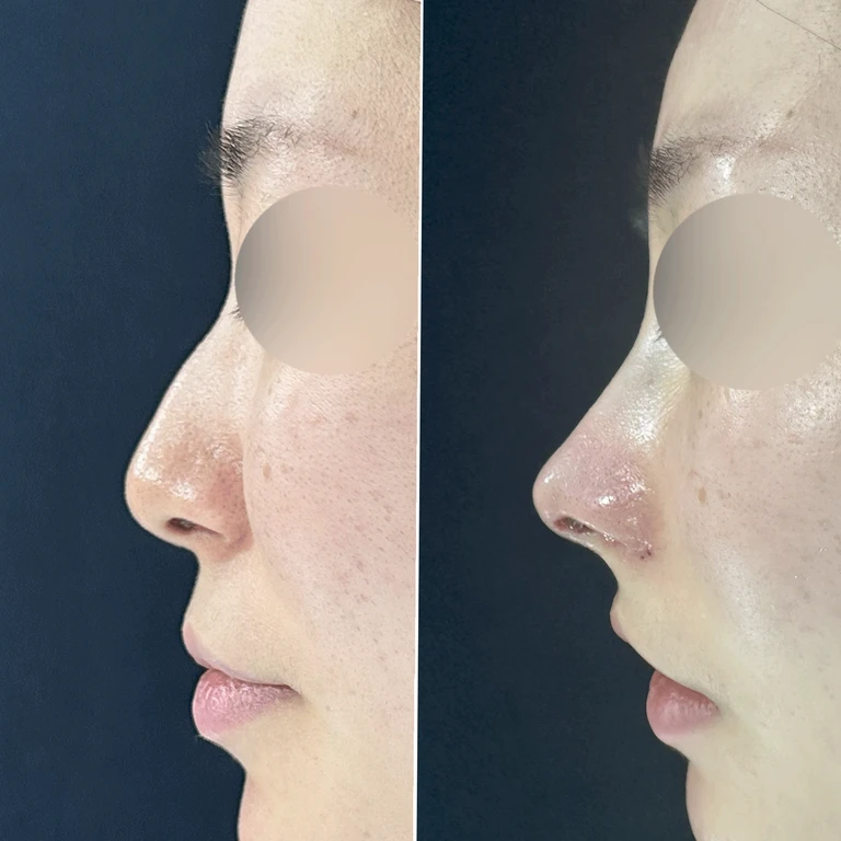 매부리코와 휜 코에 코막힘이 함께 오는 이유, 복합 교정은 어떻게 하나 — 전후 비교