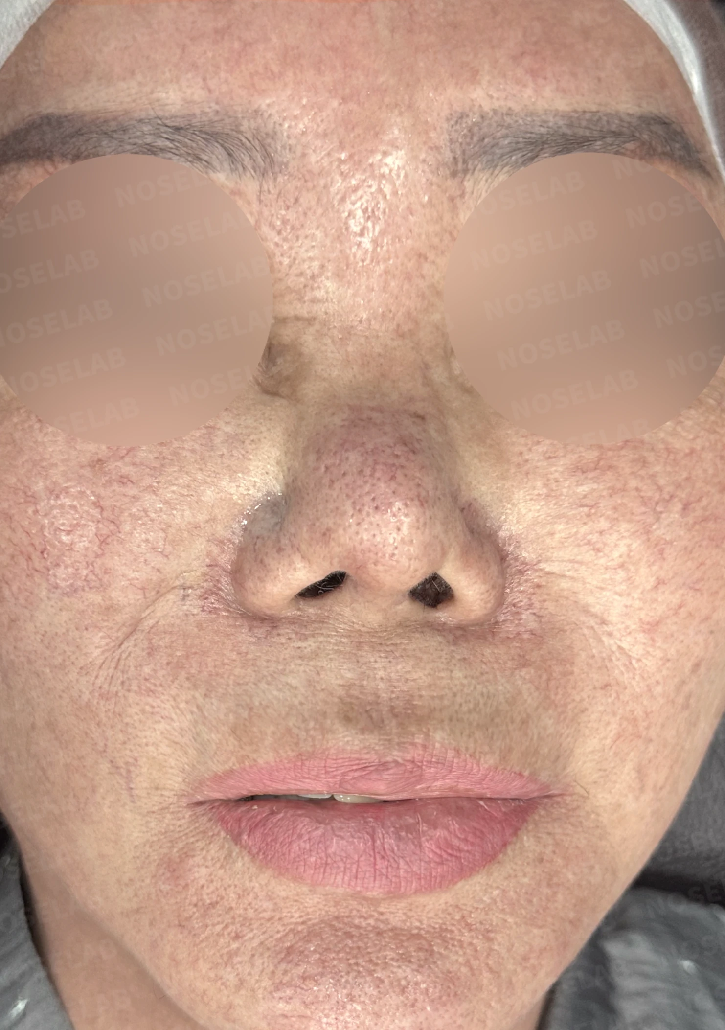 보형물 염증으로 손상된 코, 휴식기 후 기증늑연골로 안전하게 재건한 코재수술 — 전(좌) 직후(후)