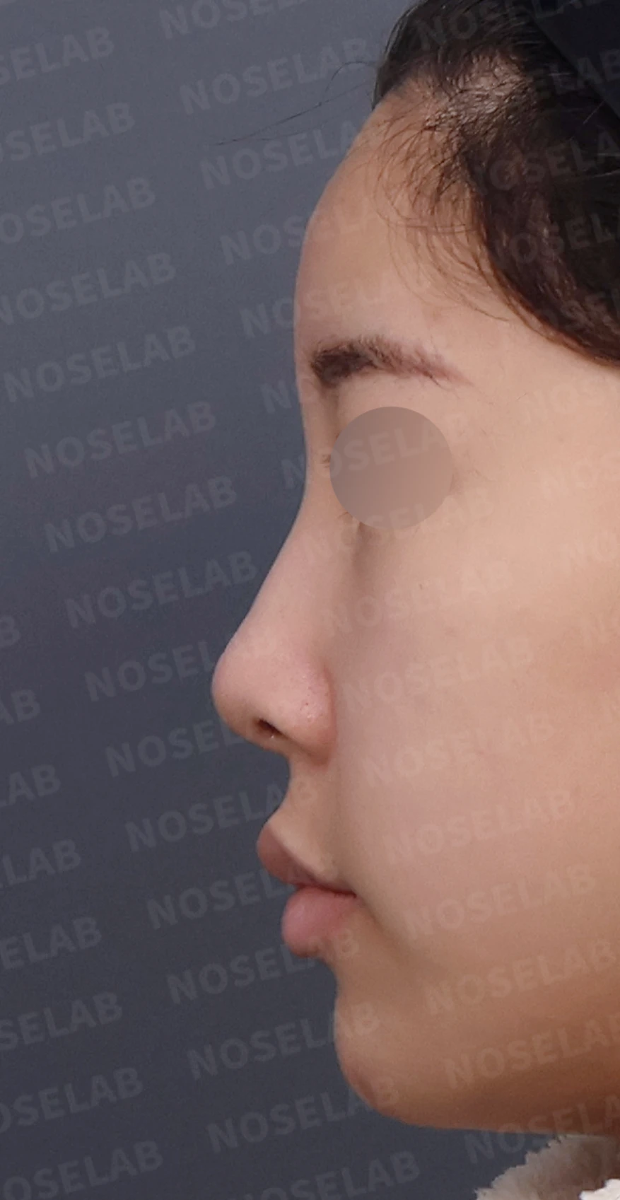 콧대가 넓고 단차져 보이는 이유, 절골술과 늑연골 코끝 성형은 어떻게 하나 — 디자인 상담 정면, 좌측 측면, 비스듬한 측면 사진입니다.