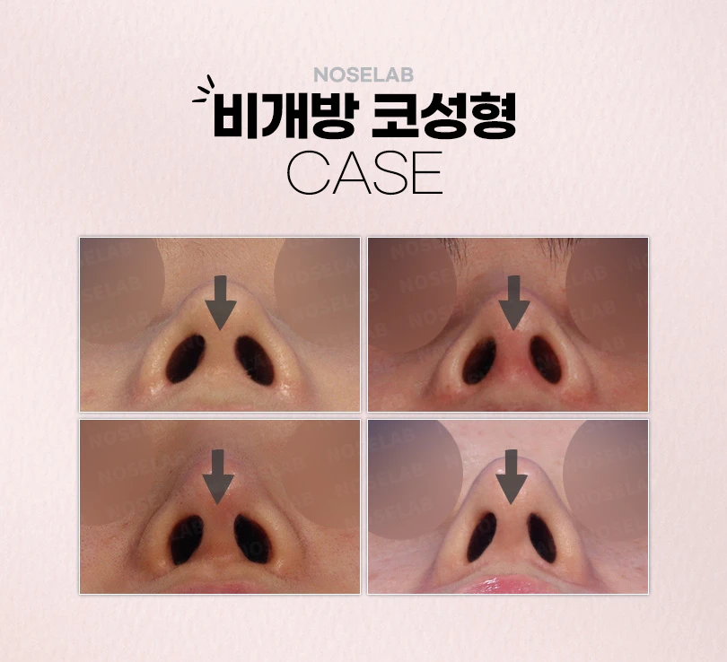 강차영원장의 고난도 코재수술 비개방코성형 수술 방법 — 본문 사진 3
