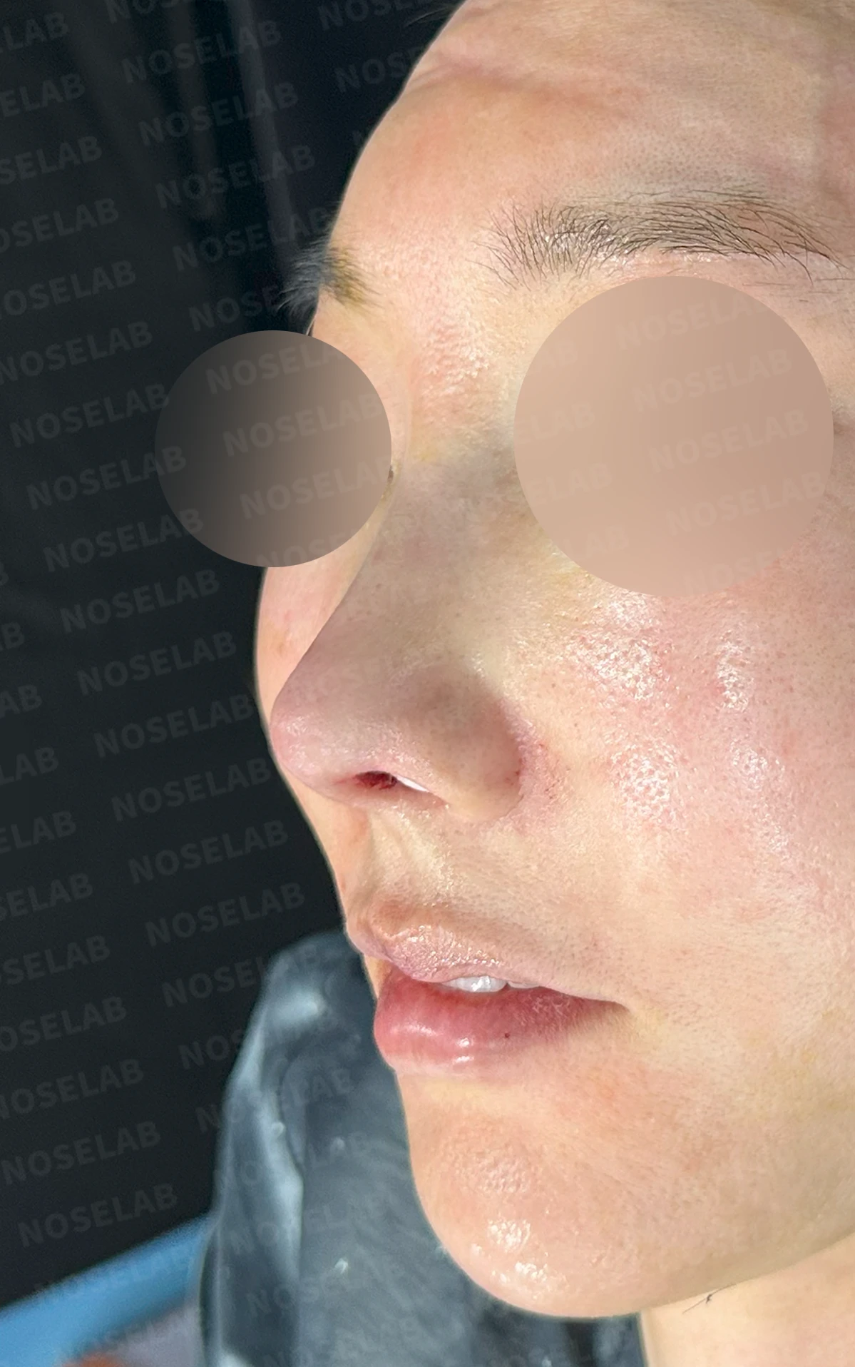 매부리를 깎은 뒤 다시 매부리가 보이고 콧구멍이 드러나는 이유 — 수술 직후 0일 정면, 측면, 비스듬한 측면 사진 직후 사진은 부기가 있는 상태로 최종 결과와 다를 수 있습니다.