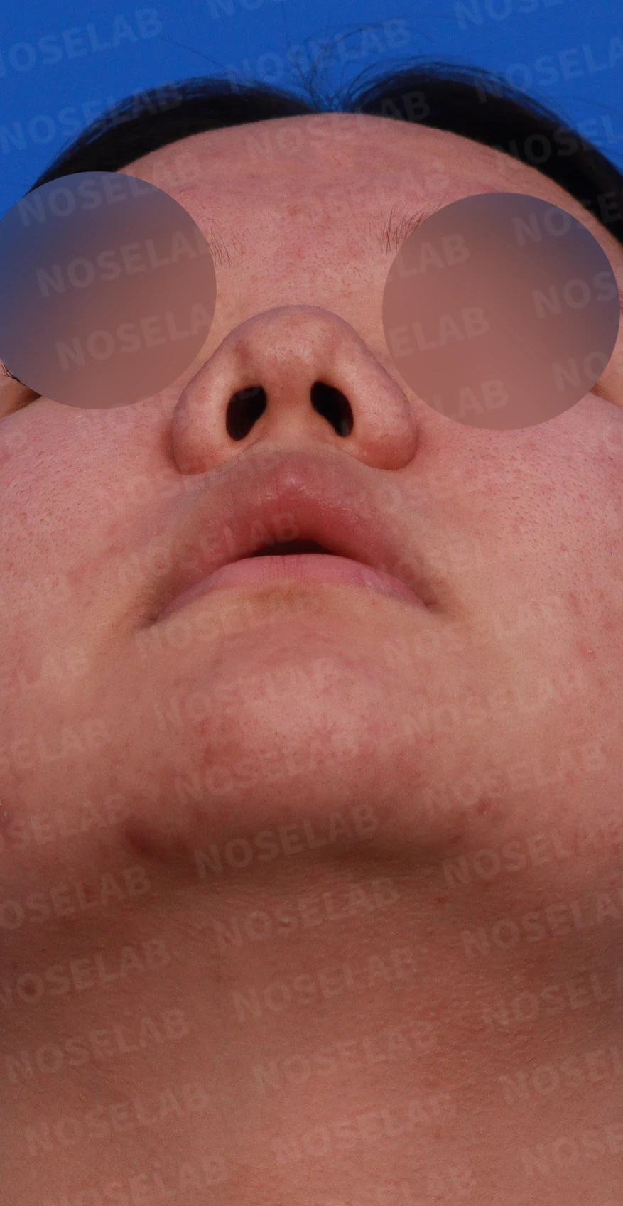 복코와 짧은 코, 비주 함몰이 함께 나타나는 이유와 코끝 입체감을 만드는 방법 — 디자인 상담 우측 비스듬한 측면, 측면, 비공 사진