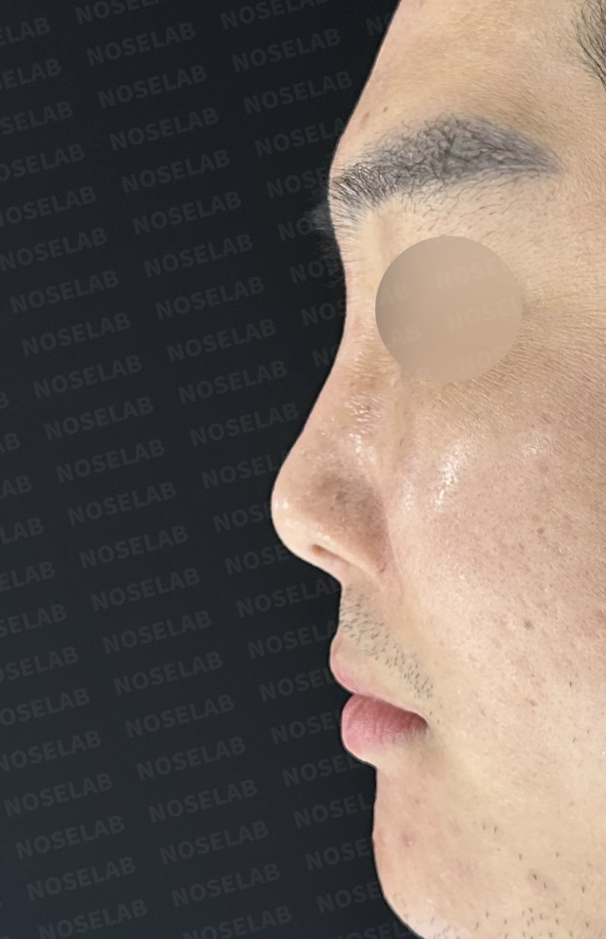 휜코 교정과 비공 비대칭, 자가늑연골로 바로잡은 코재수술 — 전(좌) 직후(후)