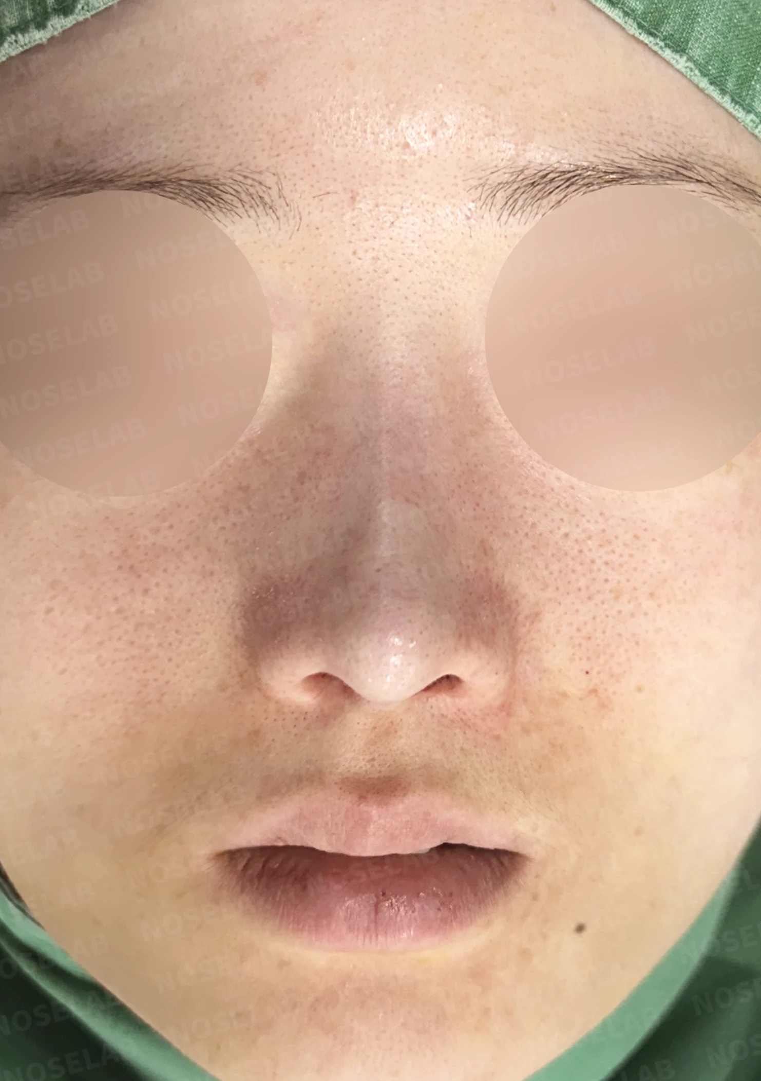보형물 비침과 들린 코, 자가늑연골로 안전하게 교정한 코재수술 — 전(좌) 직후(후)