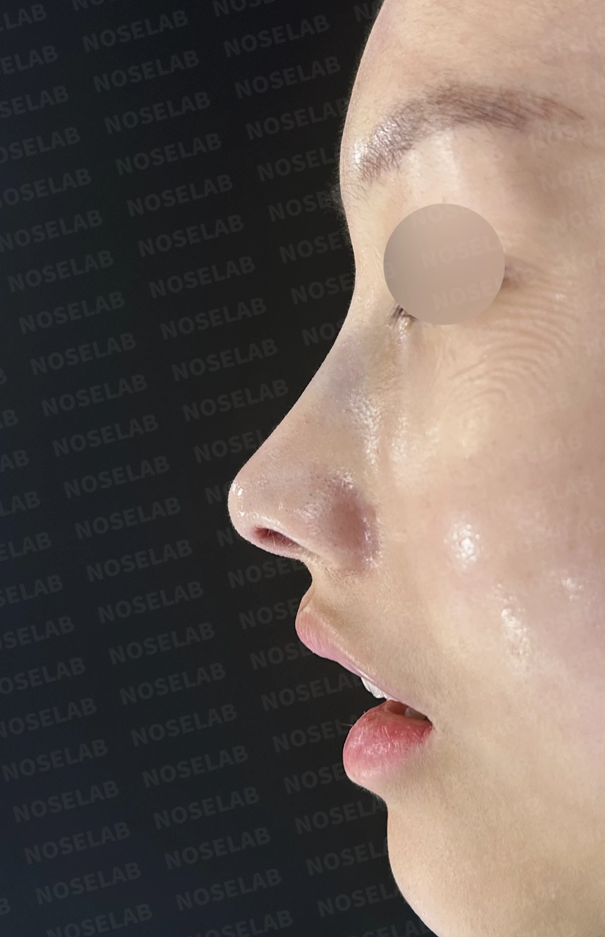 무보형물 코성형, 휘어진 콧대와 처진 코끝을 자연스럽게 교정 — 직후 정면, 비스듬한 측면, 측면 사진입니다.
