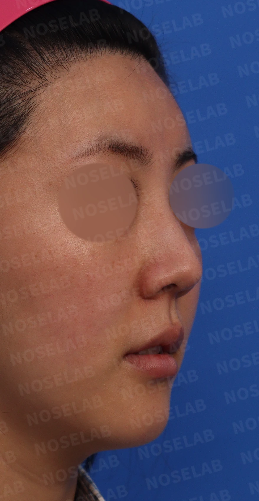 매부리코와 코끝의 모양을 함께 교정하는 방법 — 본문 사진 3