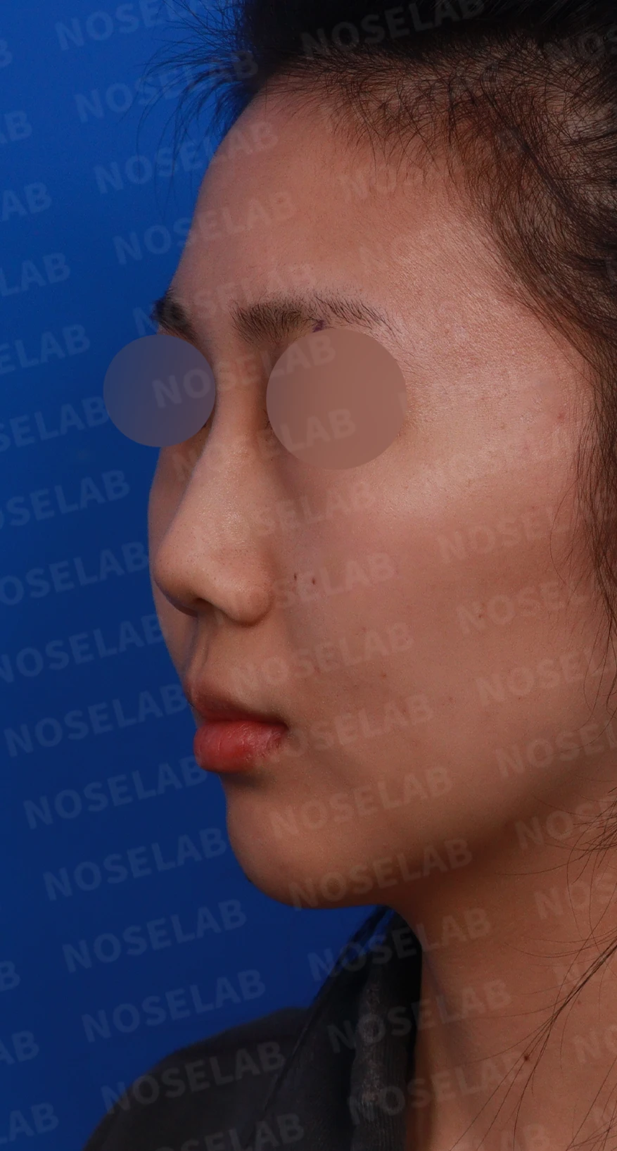 작은 코와 비공 비대칭을 함께 살펴보는 교정 방법 — 본문 사진 2