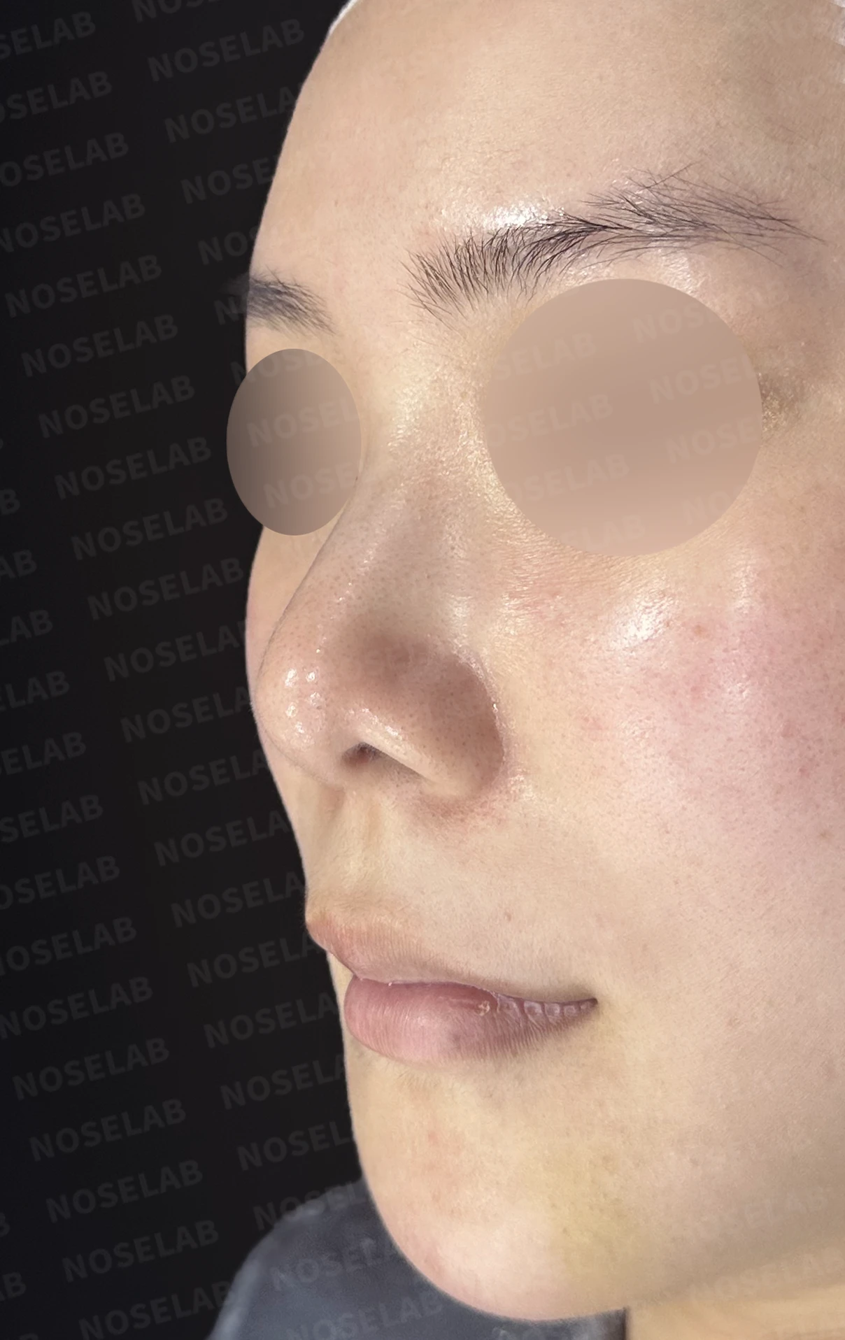 들린 코와 한쪽만 찝힌 콧구멍이 생기는 이유, 무보형물 재건은 어떻게 하나 — 수술 전 / 수술 직후 0일 직후 사진은 부기가 있는 상태로 최종 결과와 다를 수 있습니다.